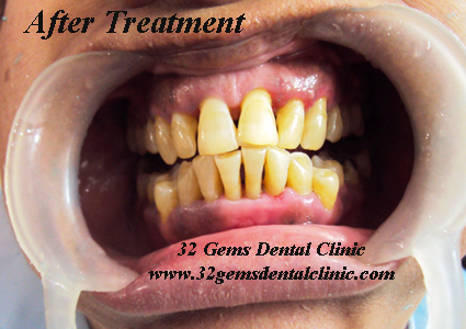 After Treatment